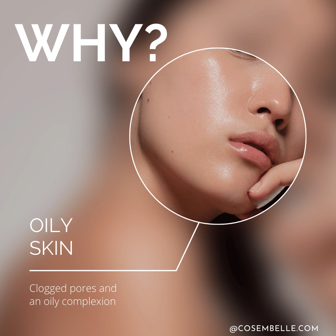 Why is your skin oily? Learn causes of oily skin and how to manage excess oil for a clear complexion.